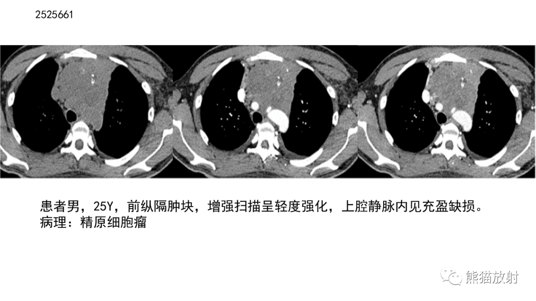 【病例】胸腺神经内分泌肿瘤2例CT影像-43