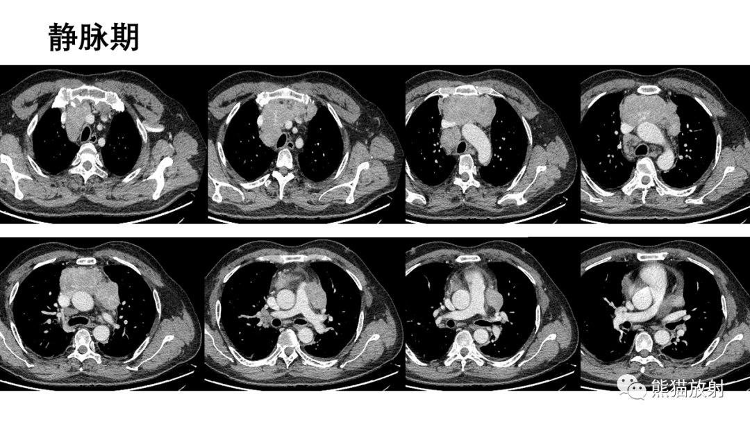 【病例】胸腺神经内分泌肿瘤2例CT影像-6