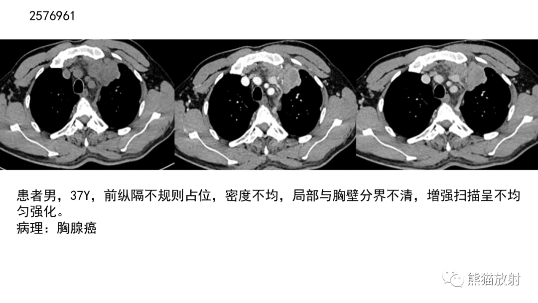 【病例】胸腺神经内分泌肿瘤2例CT影像-31