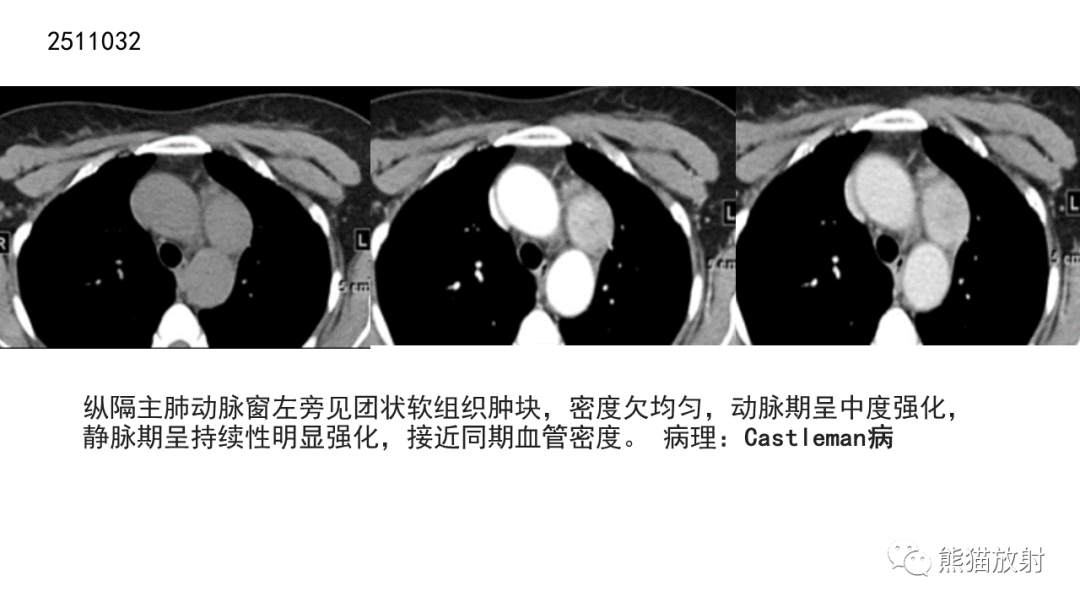 【病例】胸腺神经内分泌肿瘤2例CT影像-35