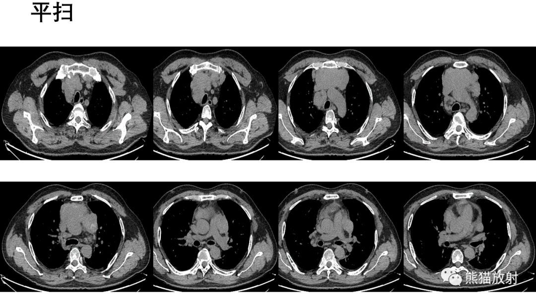 【病例】胸腺神经内分泌肿瘤2例CT影像-5