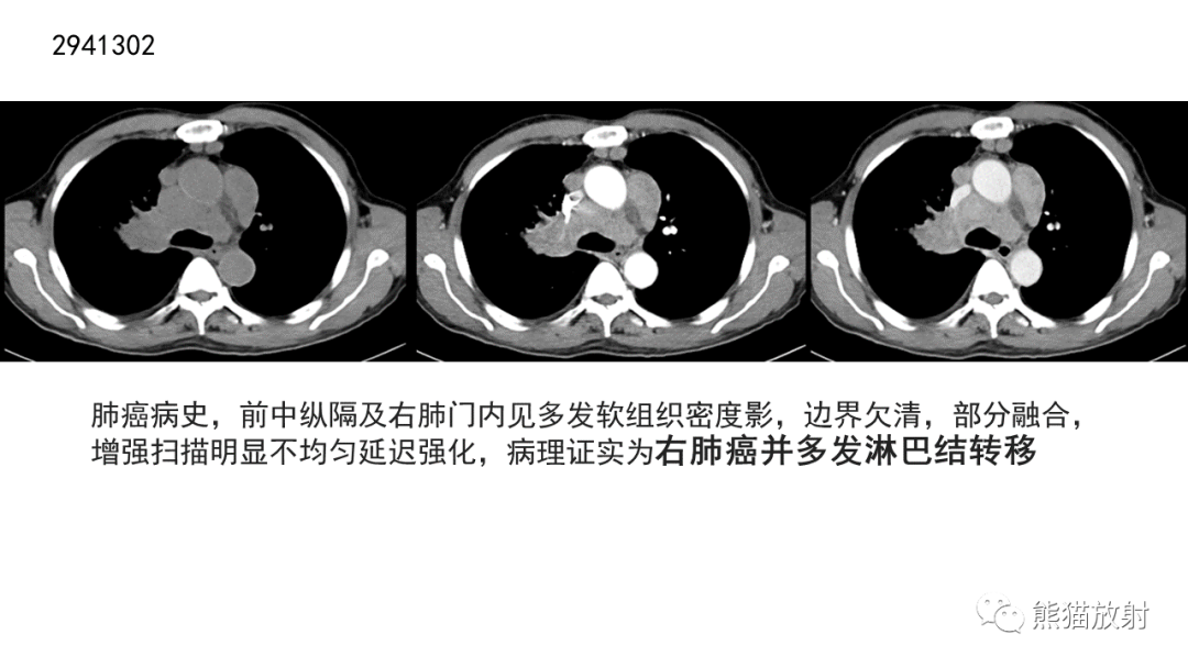 【病例】胸腺神经内分泌肿瘤2例CT影像-37