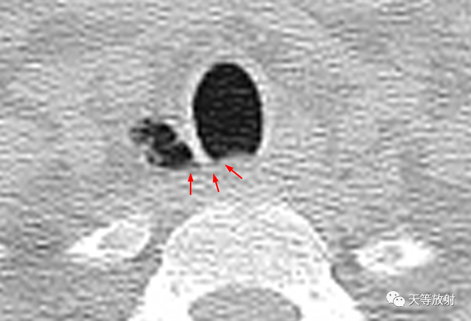 【病例】气管憩室1例CT影像-4 【病例】气管憩室1例CT影像-4