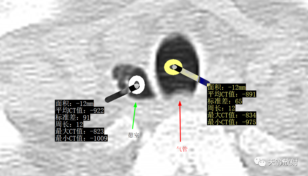 【病例】气管憩室1例CT影像-3 【病例】气管憩室1例CT影像-3