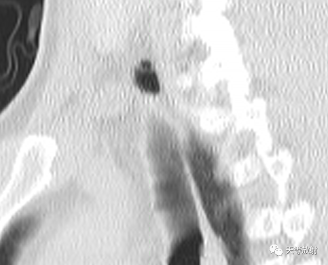 【病例】气管憩室1例CT影像-8 【病例】气管憩室1例CT影像-8