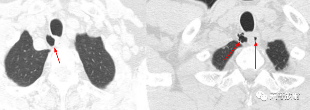 【病例】气管憩室1例CT影像-11 【病例】气管憩室1例CT影像-11