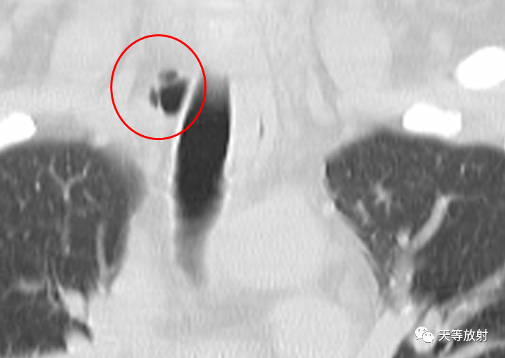 【病例】气管憩室1例CT影像-7 【病例】气管憩室1例CT影像-7