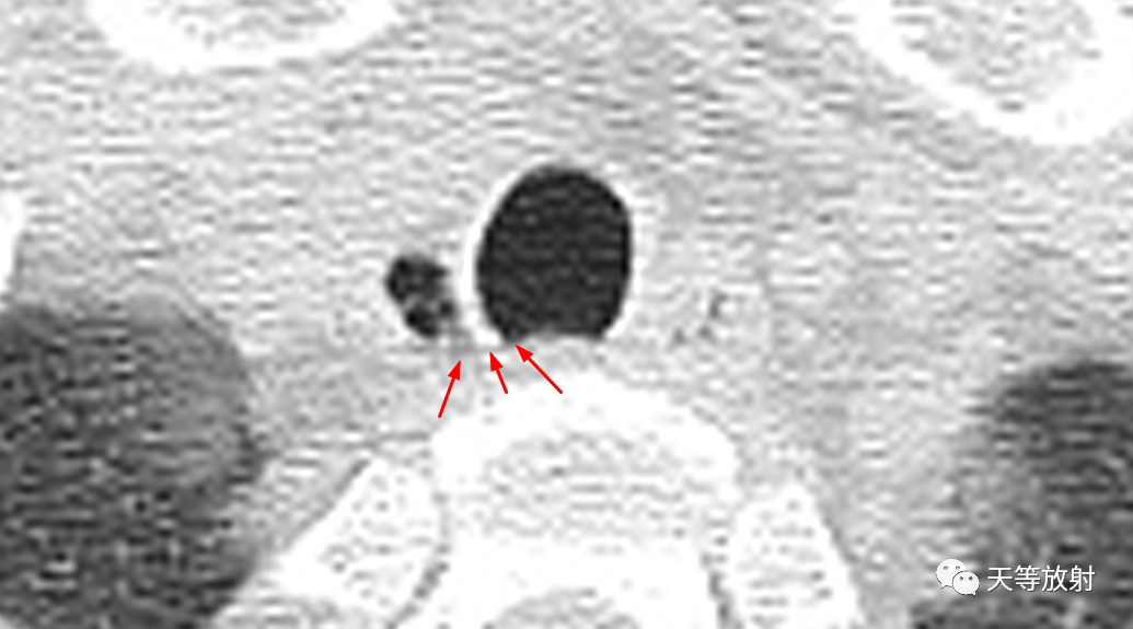 【病例】气管憩室1例CT影像-5 【病例】气管憩室1例CT影像-5