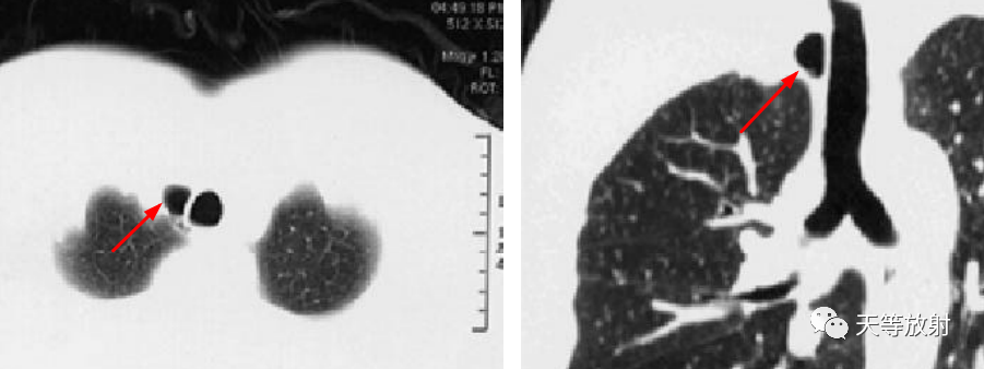 【病例】气管憩室1例CT影像-12 【病例】气管憩室1例CT影像-12