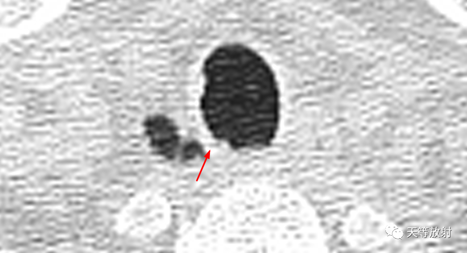 【病例】气管憩室1例CT影像-6 【病例】气管憩室1例CT影像-6