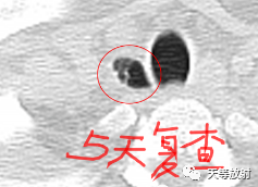 【病例】气管憩室1例CT影像-2 【病例】气管憩室1例CT影像-2