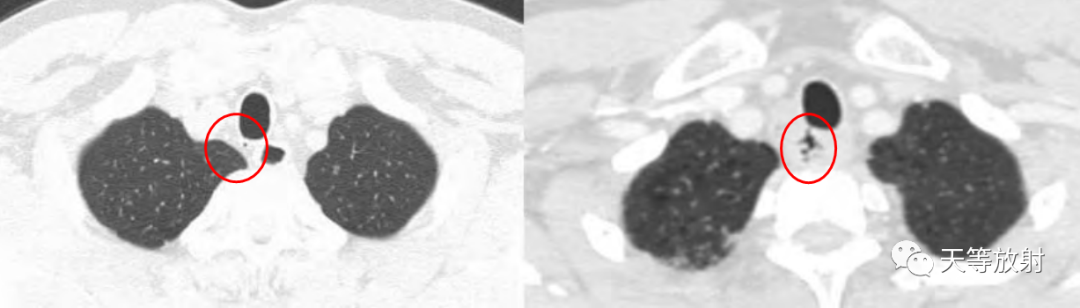 【病例】气管憩室1例CT影像-10 【病例】气管憩室1例CT影像-10