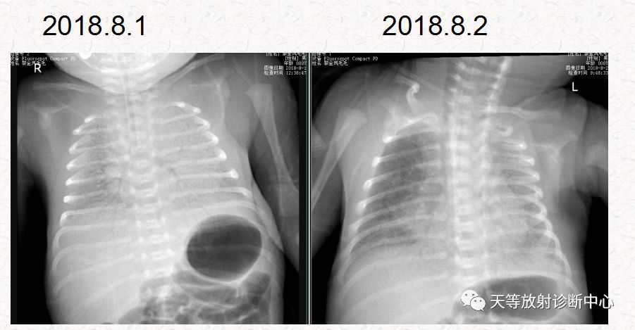 新生儿肺透明膜病HMD-2