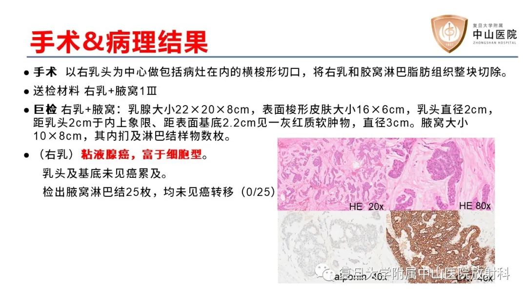 【病例】乳腺粘液腺癌1例MR影像-8