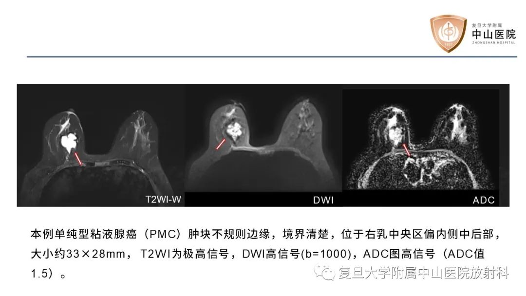 【病例】乳腺粘液腺癌1例MR影像-12