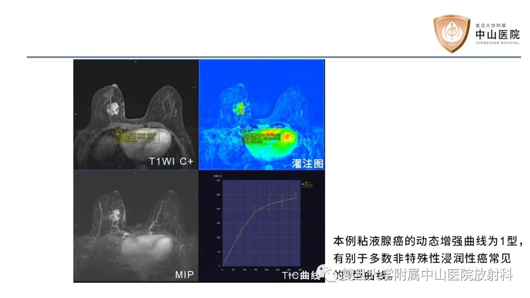 【病例】乳腺粘液腺癌1例MR影像-14