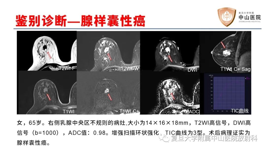 【病例】乳腺粘液腺癌1例MR影像-23