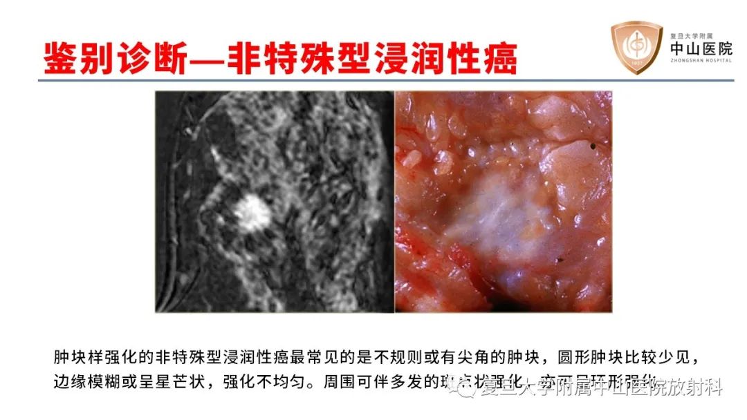 【病例】乳腺粘液腺癌1例MR影像-18