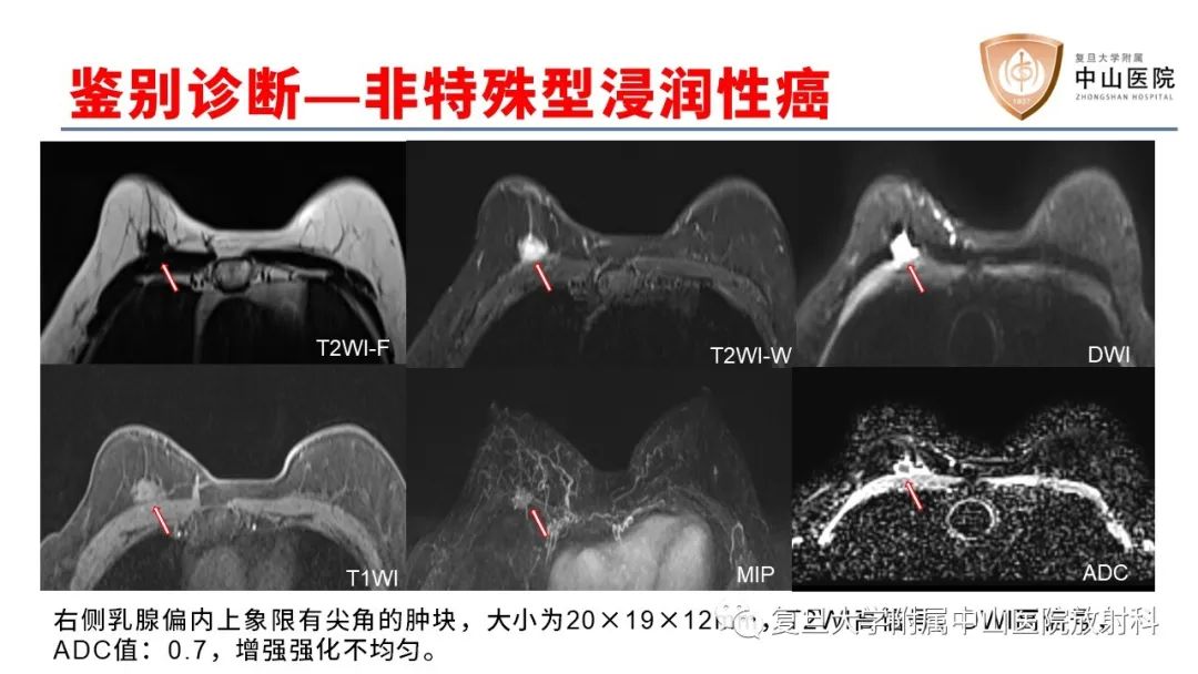 【病例】乳腺粘液腺癌1例MR影像-19