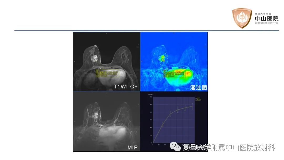 【病例】乳腺粘液腺癌1例MR影像-5