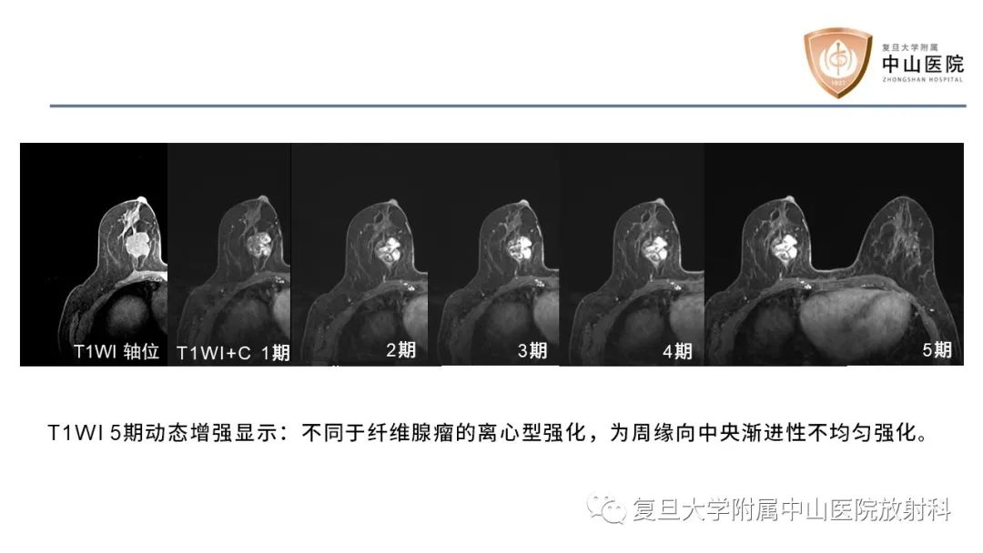 【病例】乳腺粘液腺癌1例MR影像-13