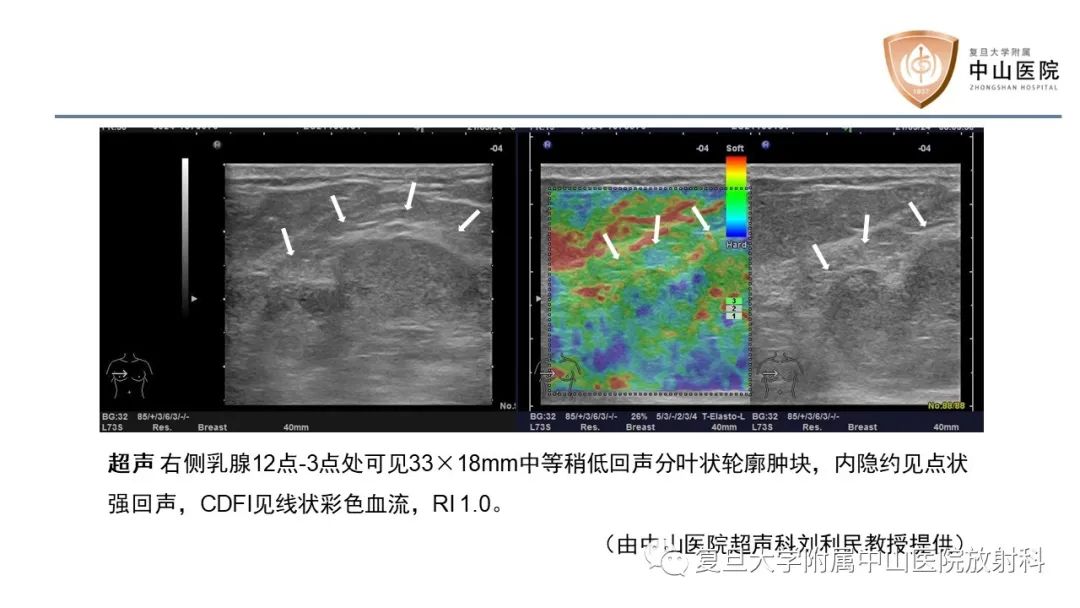 【病例】乳腺粘液腺癌1例MR影像-6
