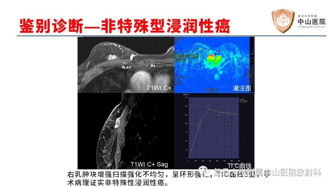 【病例】乳腺粘液腺癌1例MR影像-20
