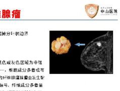乳腺粘液腺癌1例MR影像