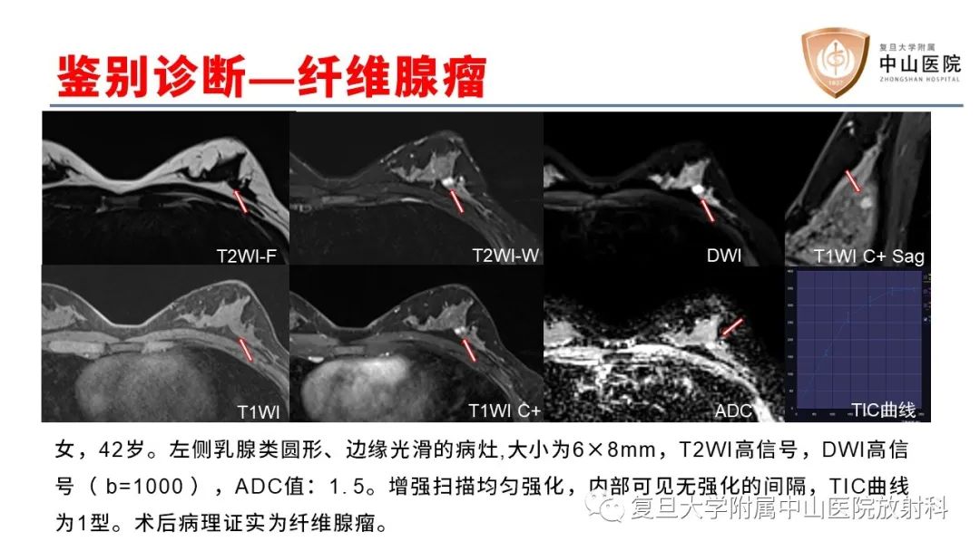 【病例】乳腺粘液腺癌1例MR影像-22