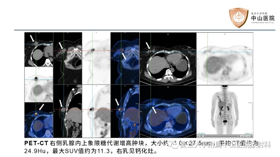 【病例】乳腺粘液腺癌1例MR影像-7