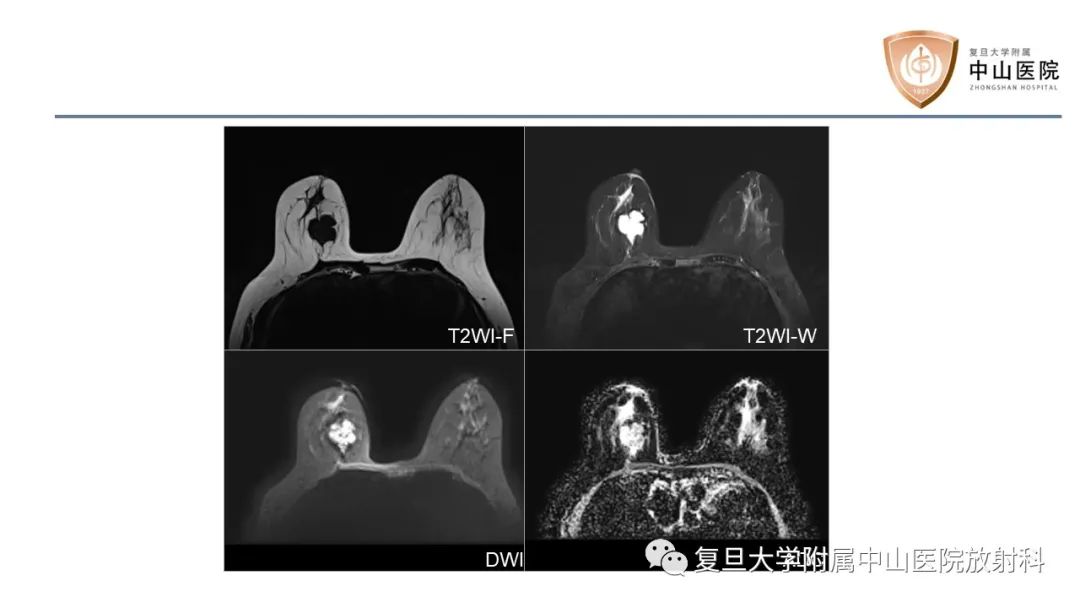 【病例】乳腺粘液腺癌1例MR影像-3