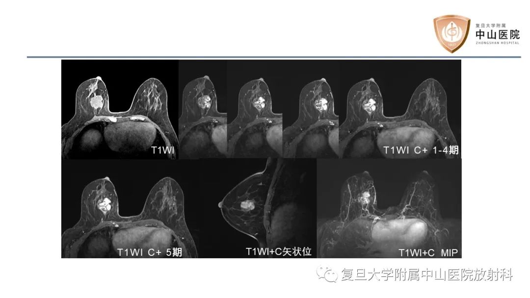 【病例】乳腺粘液腺癌1例MR影像-4