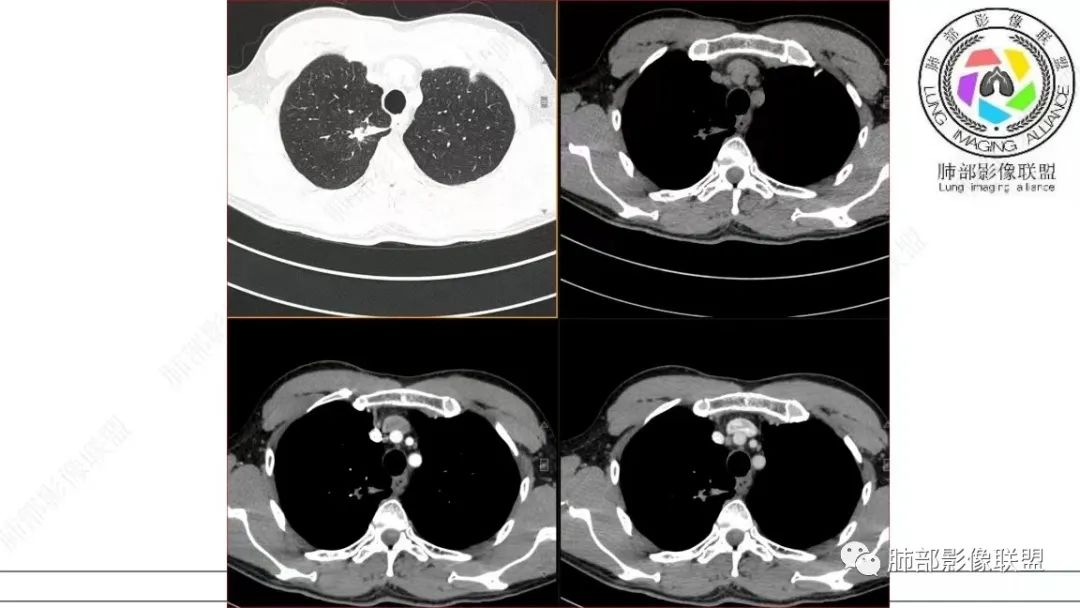 【病例】少见的细支气管腺瘤1例CT影像-19