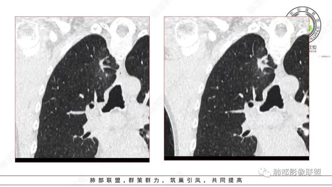 【病例】少见的细支气管腺瘤1例CT影像-8
