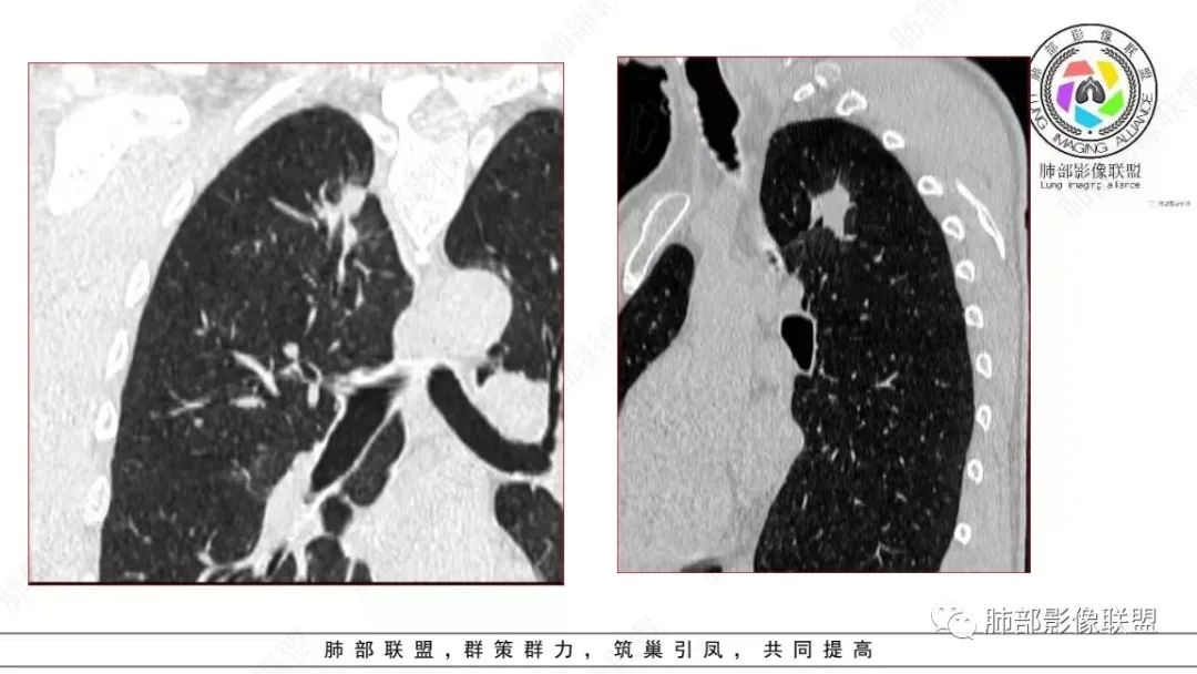 【病例】少见的细支气管腺瘤1例CT影像-12