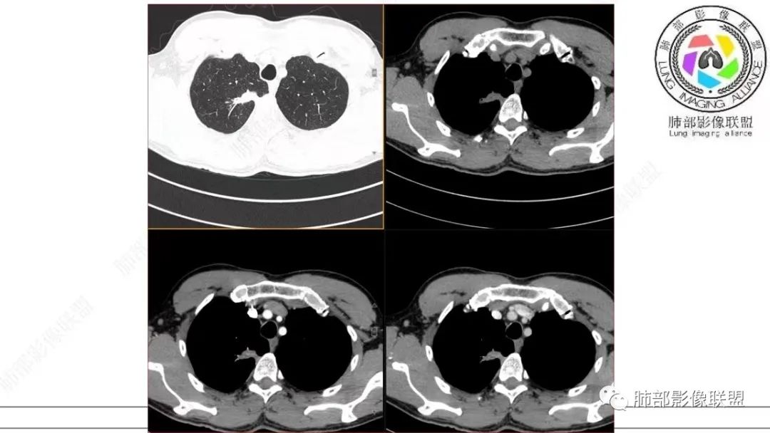 【病例】少见的细支气管腺瘤1例CT影像-17