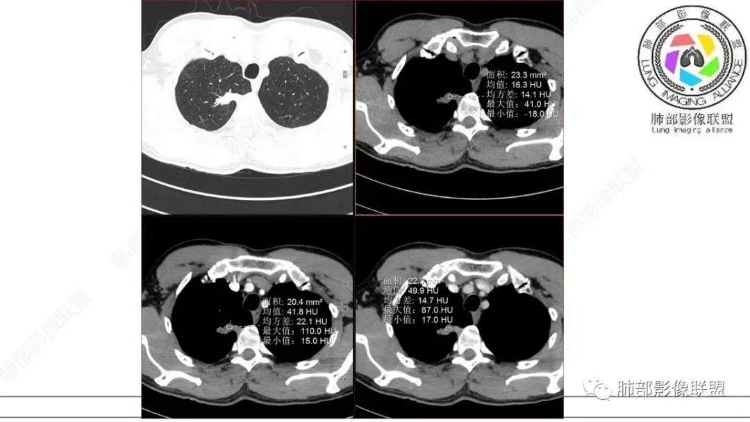 【病例】少见的细支气管腺瘤1例CT影像-20