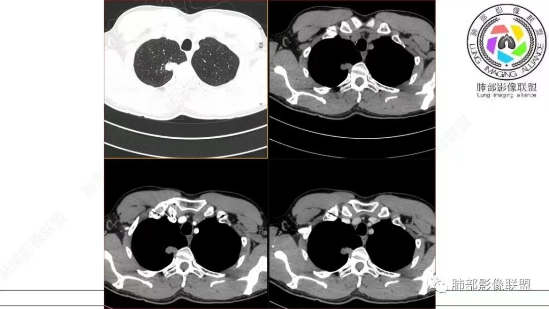 【病例】少见的细支气管腺瘤1例CT影像-15