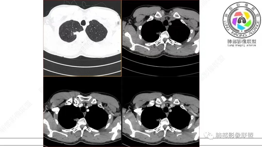 【病例】少见的细支气管腺瘤1例CT影像-13