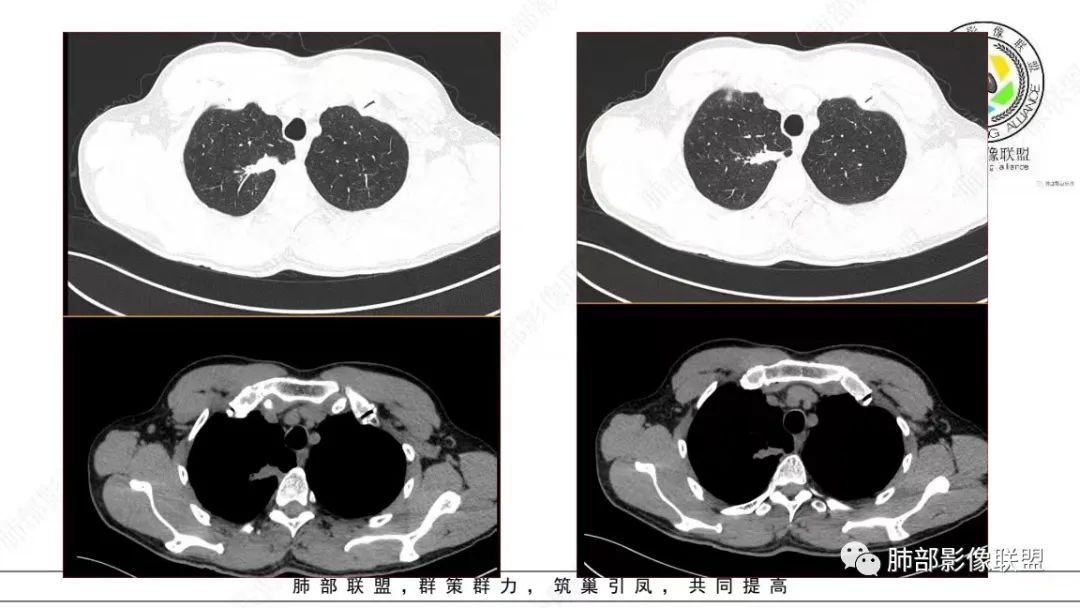 【病例】少见的细支气管腺瘤1例CT影像-6