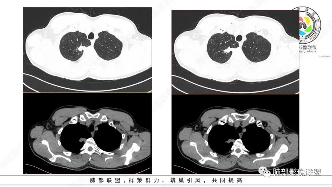 【病例】少见的细支气管腺瘤1例CT影像-5