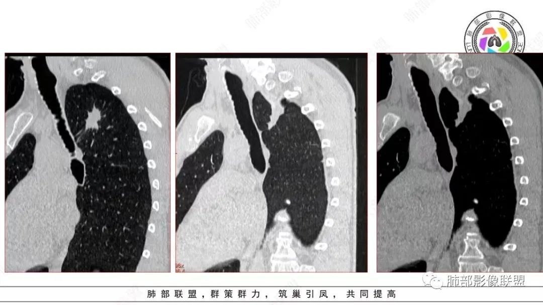 【病例】少见的细支气管腺瘤1例CT影像-14