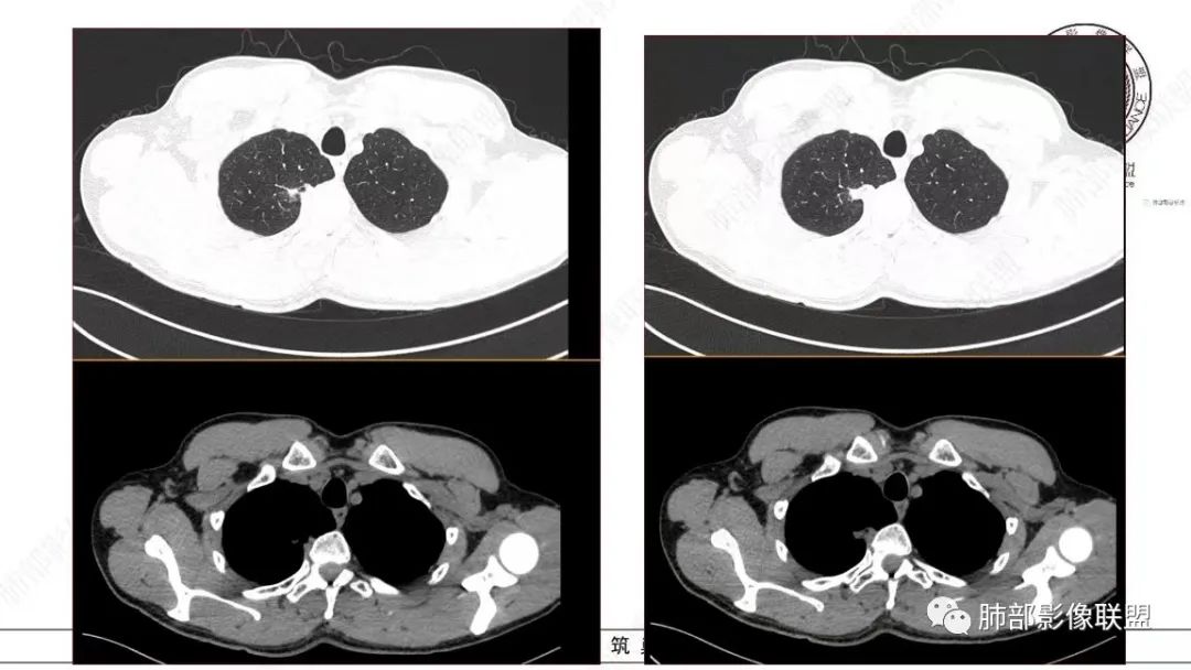 【病例】少见的细支气管腺瘤1例CT影像-4
