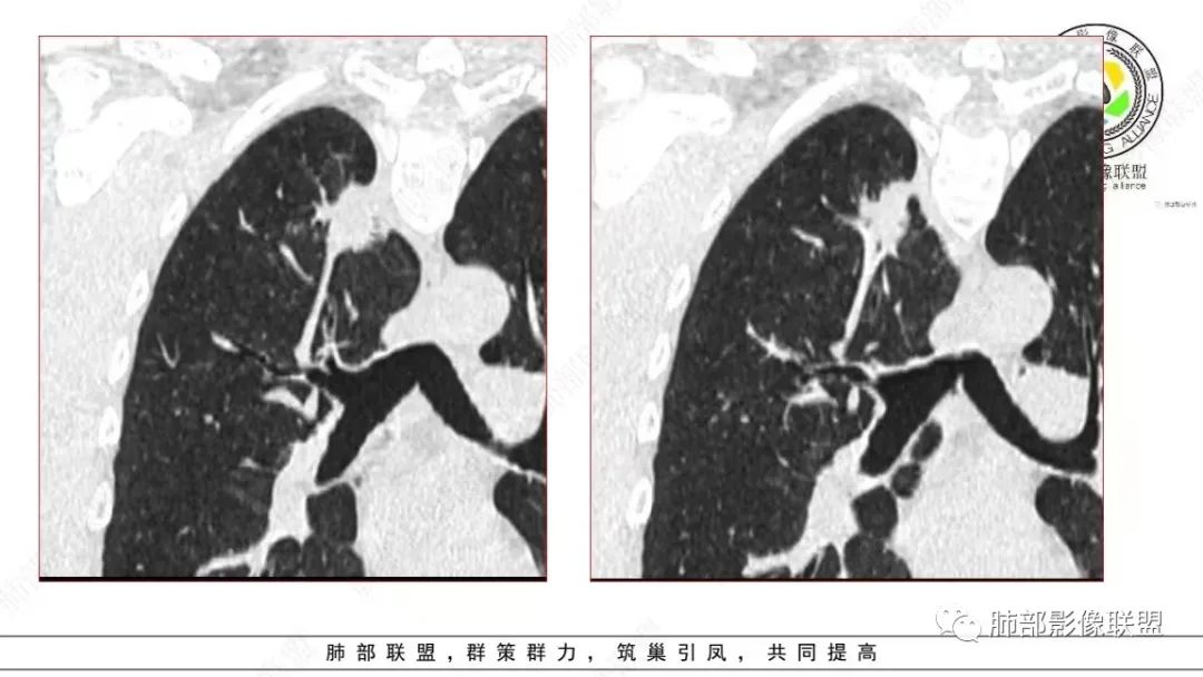 【病例】少见的细支气管腺瘤1例CT影像-11