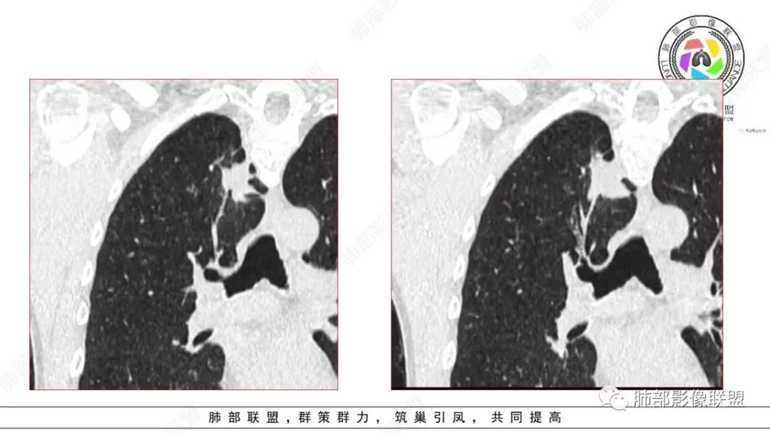 【病例】少见的细支气管腺瘤1例CT影像-9