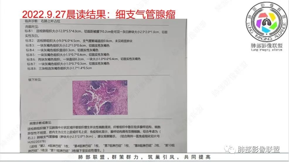 【病例】少见的细支气管腺瘤1例CT影像-24