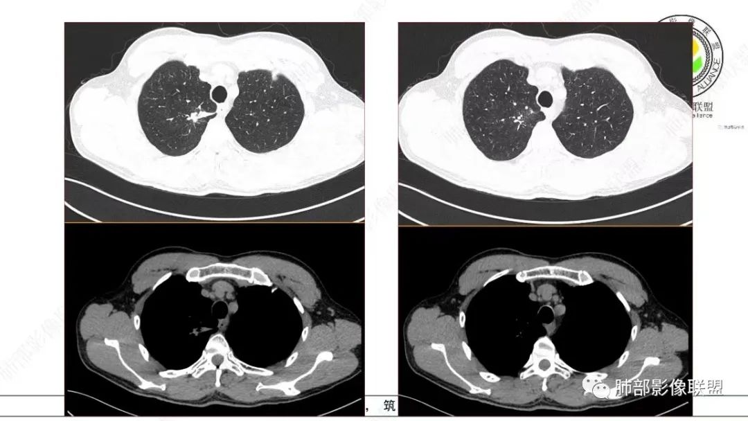【病例】少见的细支气管腺瘤1例CT影像-7
