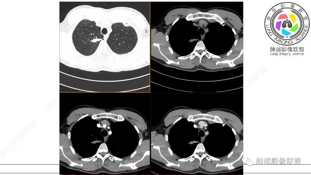 【病例】少见的细支气管腺瘤1例CT影像-18