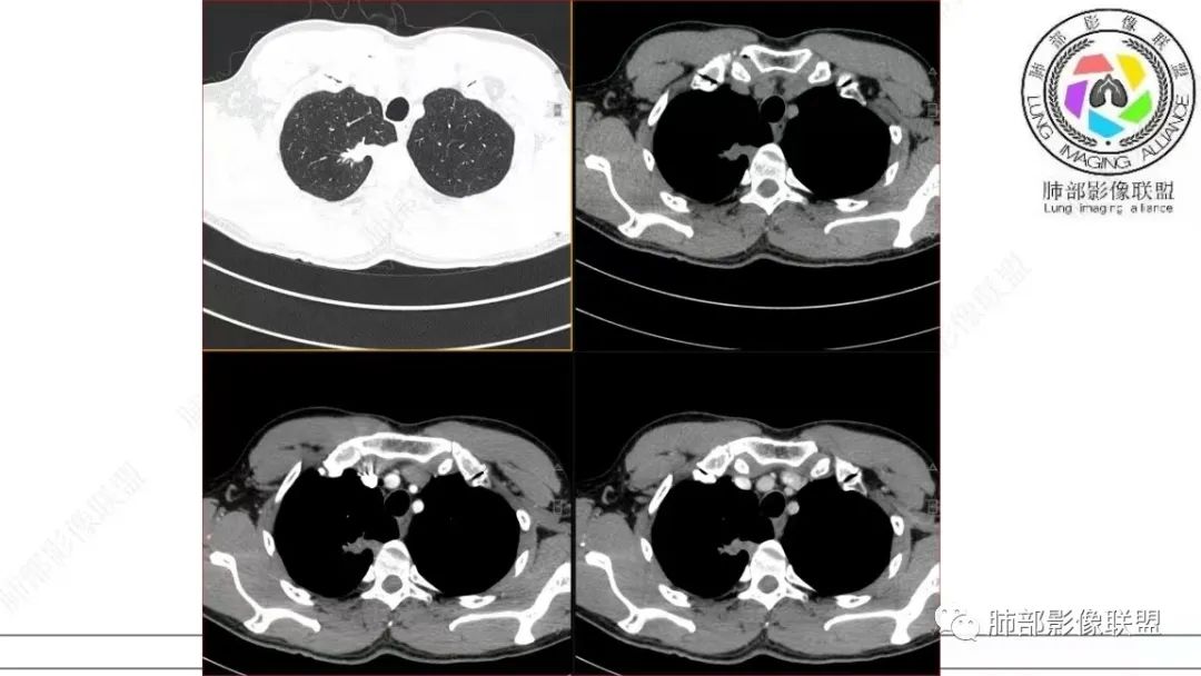【病例】少见的细支气管腺瘤1例CT影像-16