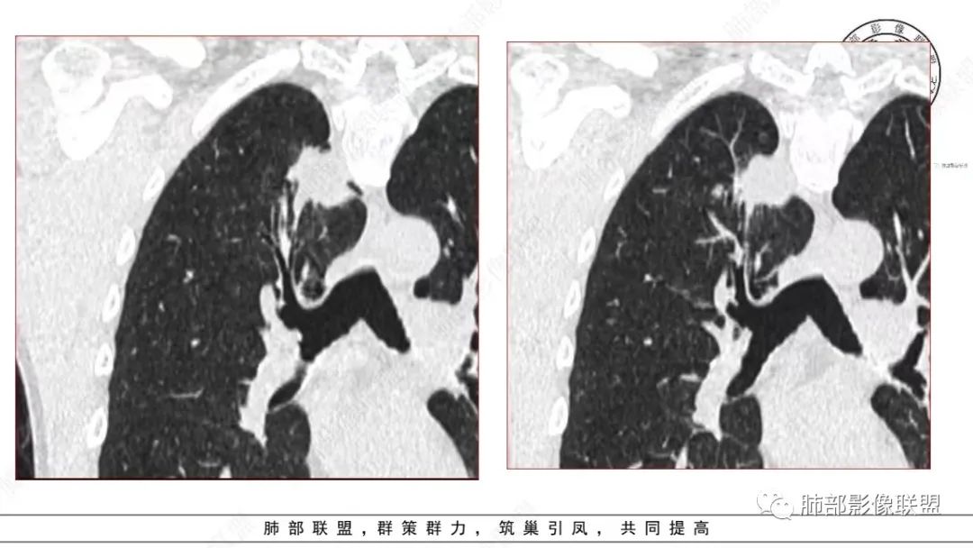 【病例】少见的细支气管腺瘤1例CT影像-10